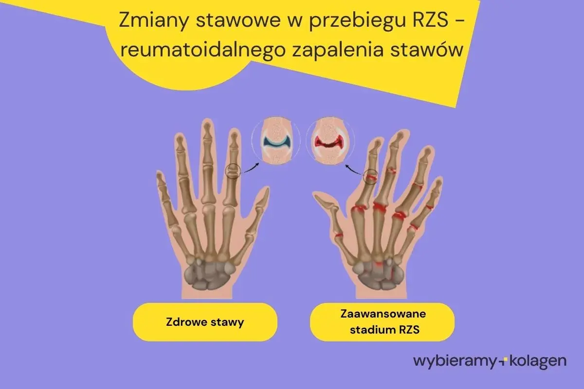 Porównanie zdrowych stawów dłoni z zaawansowanym stadium RZS, gdzie widoczne są zmiany zapalne i uszkodzenia kości.